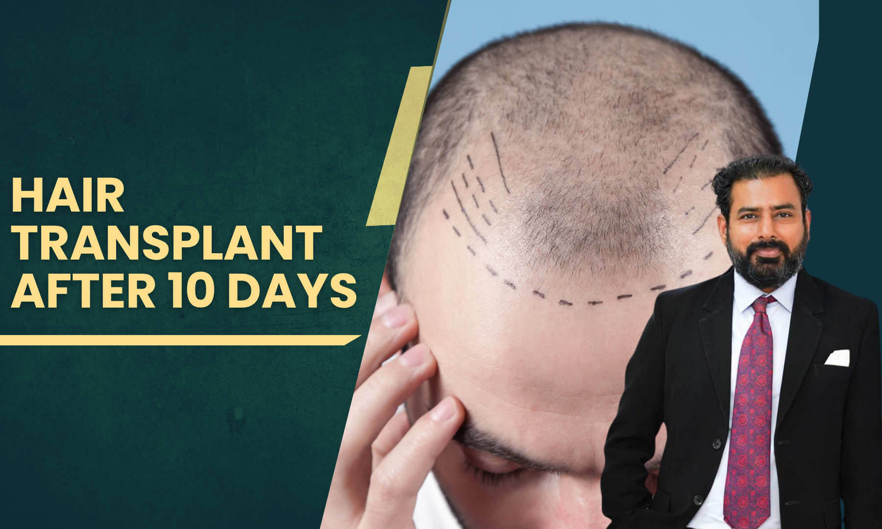 _Hair_transplant_after_10_days